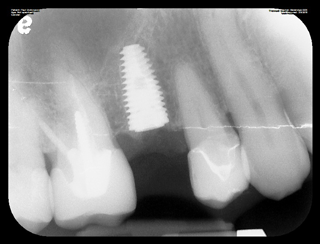 Dental implant x-ray image actual patient at Beveridge Dental in San Jose