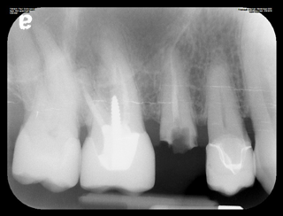 Dental implants x-ray image with implant rod placement at Beveridge Dental