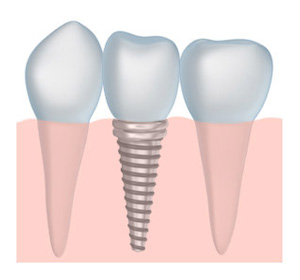 Dental Implant Illustration - Beveridge Dental in San Jose