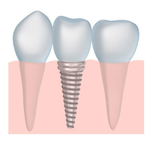 Visual Representation of Dental Implant Crown Placement at Beveridge Dental in South San Jose