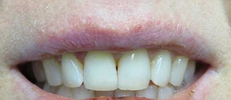 after chipped tooth repair San Jose CA