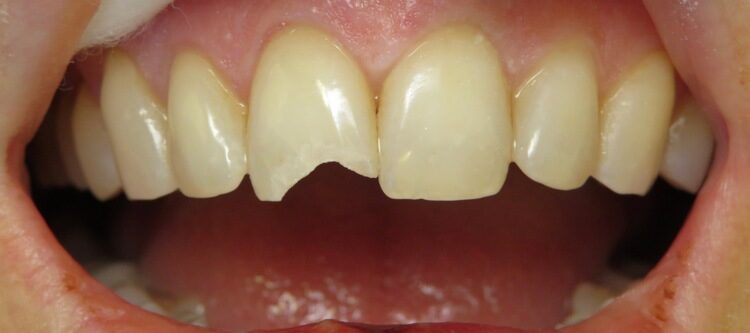 before chipped tooth repair San Jose CA