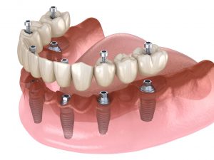 Implant Supported Dentures - Beveridge Dental San Jose CA