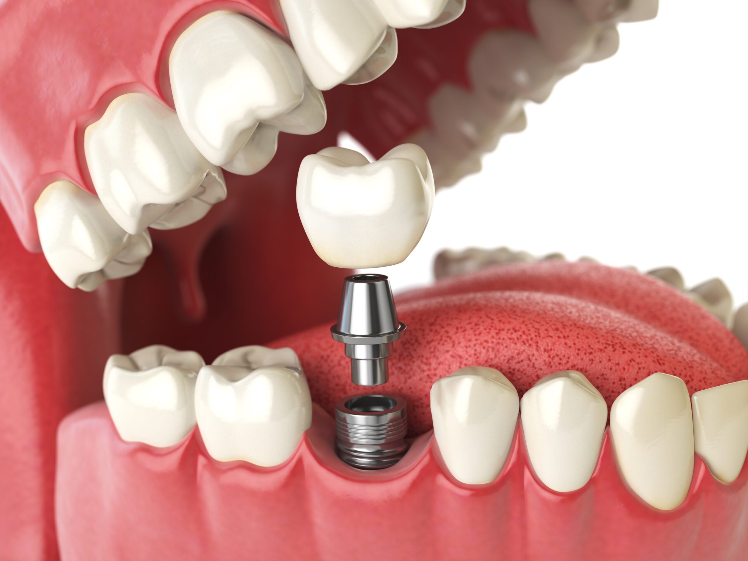 The best dental implant dentist in San Jose CA