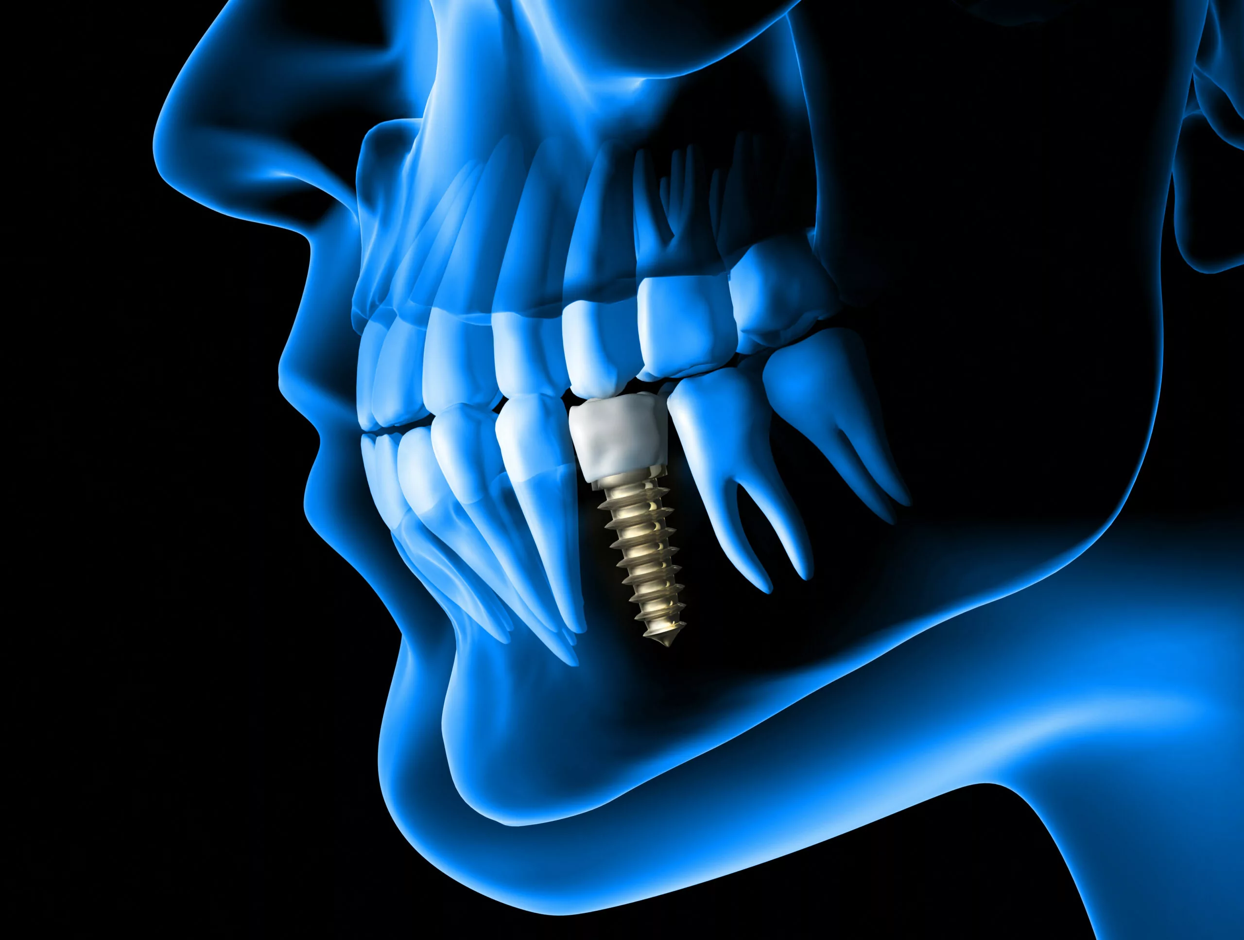 the best tooth implant dentist in San Jose CA