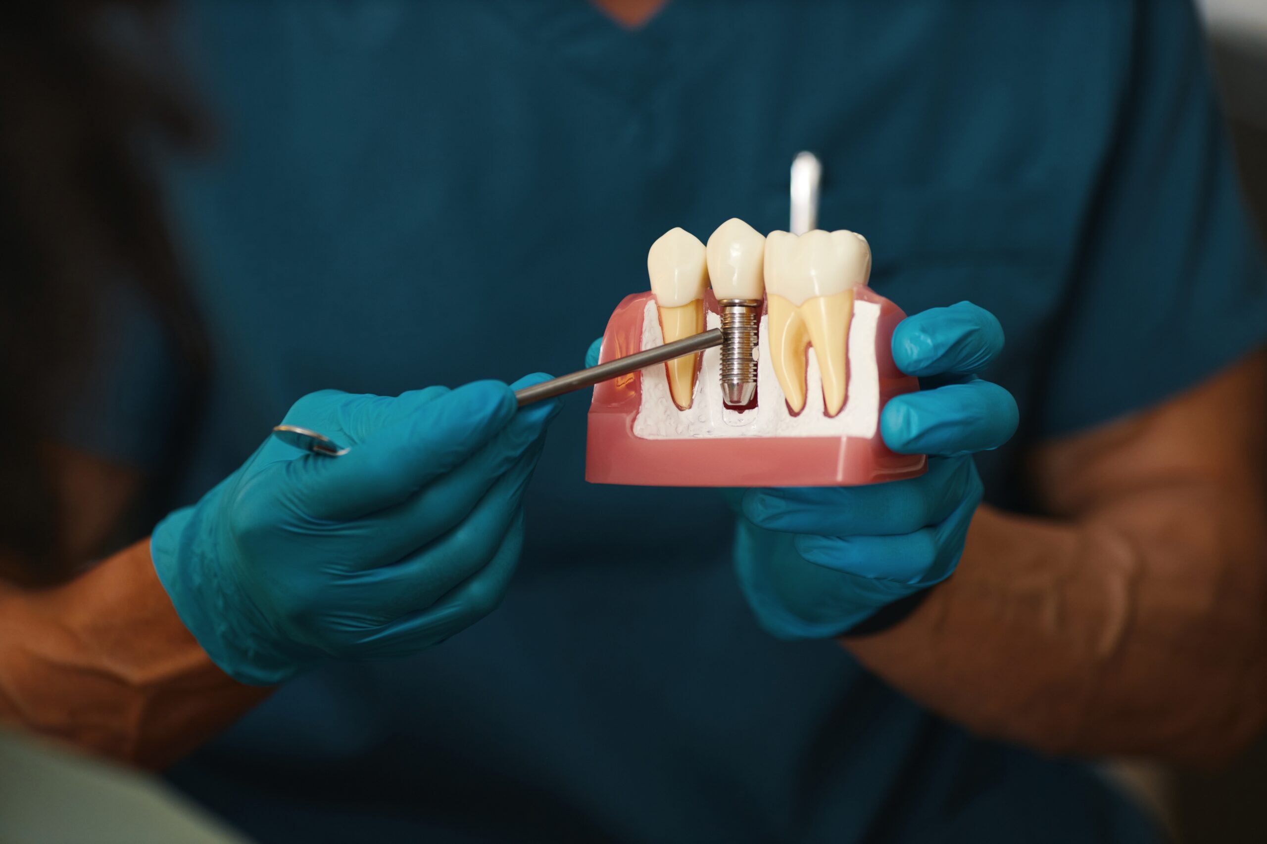 San Jose dentist showing a patient a model of a dental implant