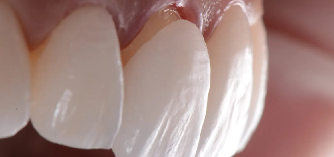 closeup of a dental veneer application