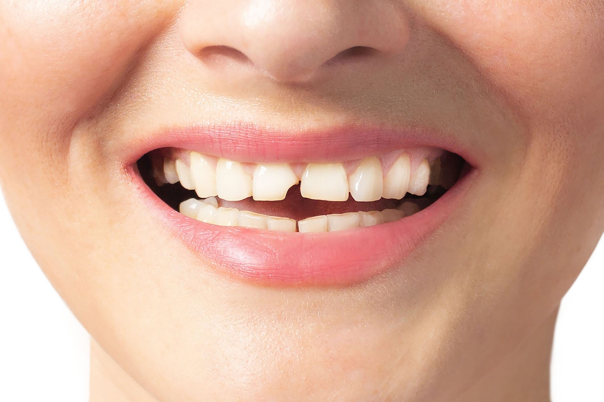 closeup of a woman with chipped front tooth