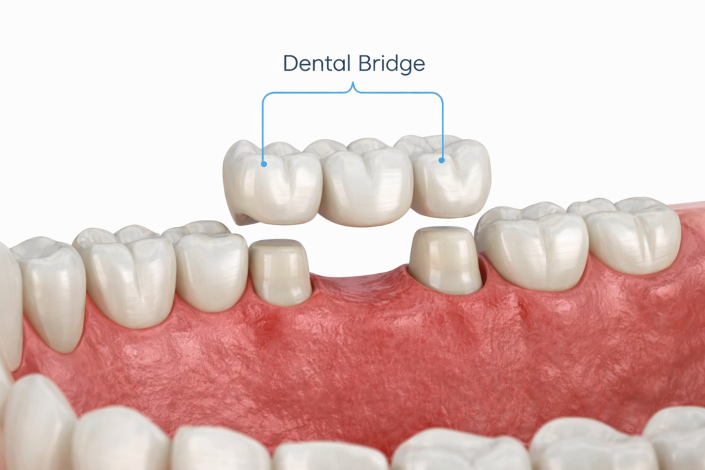 a dental bridge, similar to the ones placed by a Beveridge Dental in San Jose