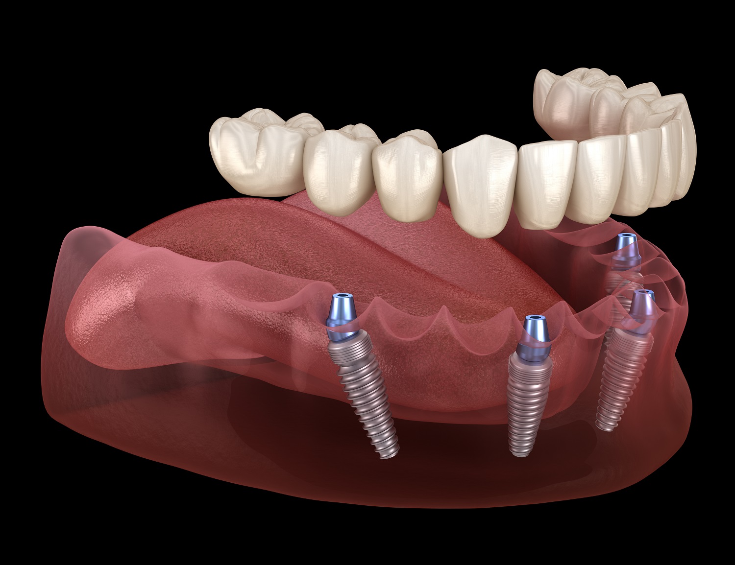implant supported denture diagram