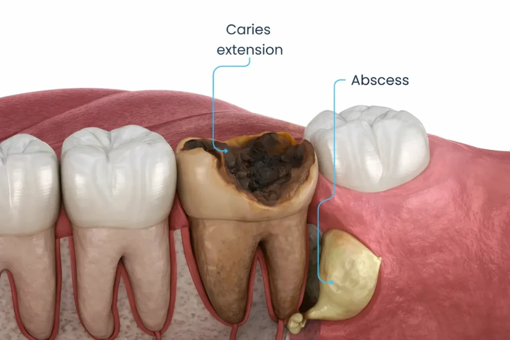 diagram of a tooth abscess