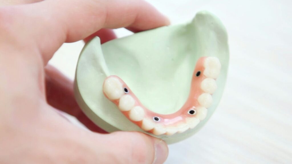 An Jose dentist molding all on 4 implant dentures