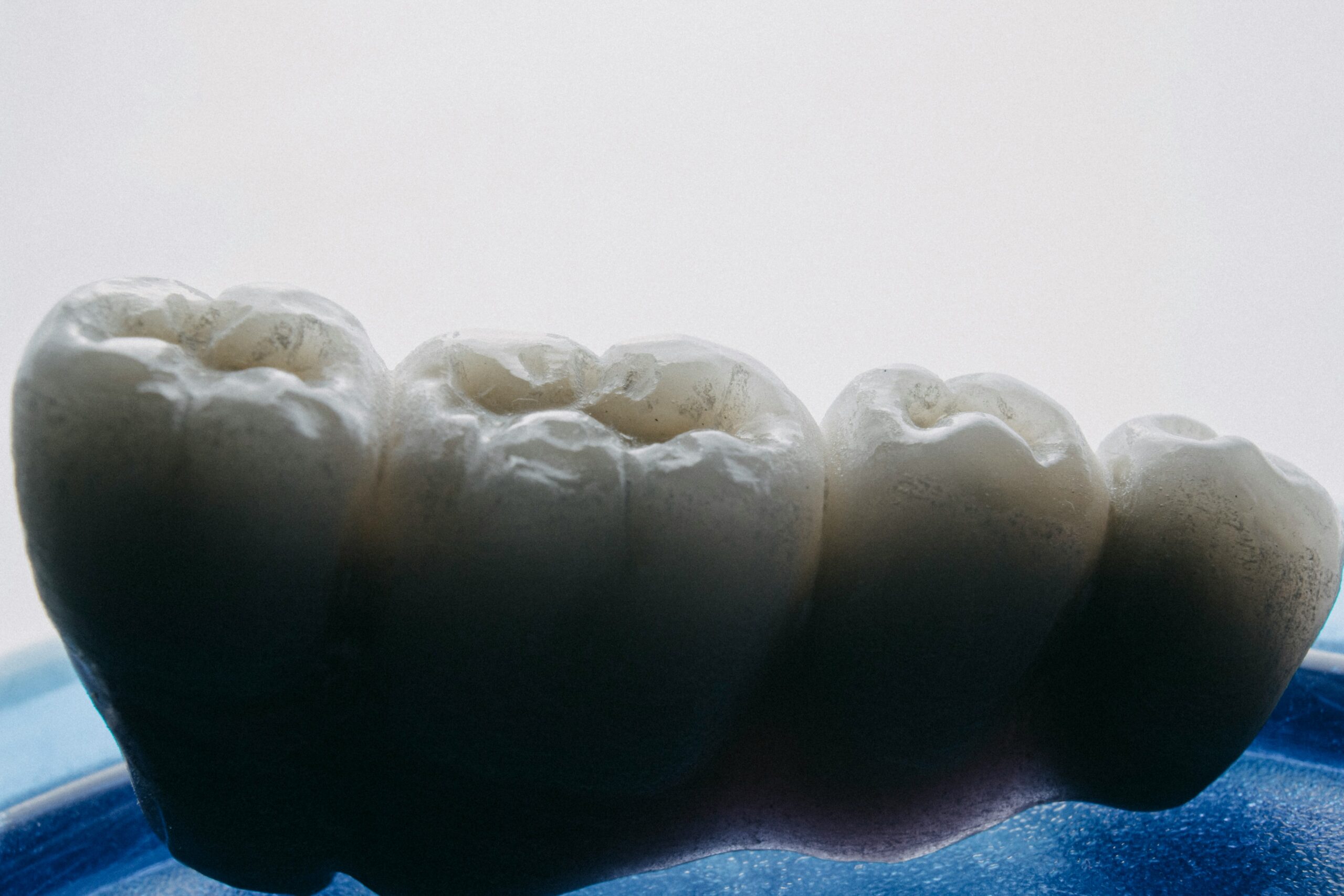 dental bridge at San Jose CA dentist office