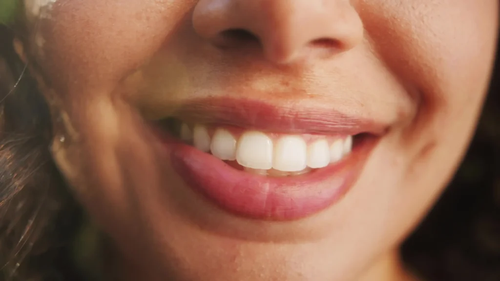 composite veneers in san jose