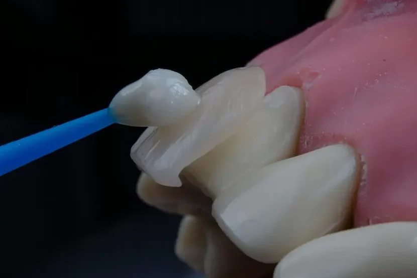 porcelain veneers San Jose dental veneers
