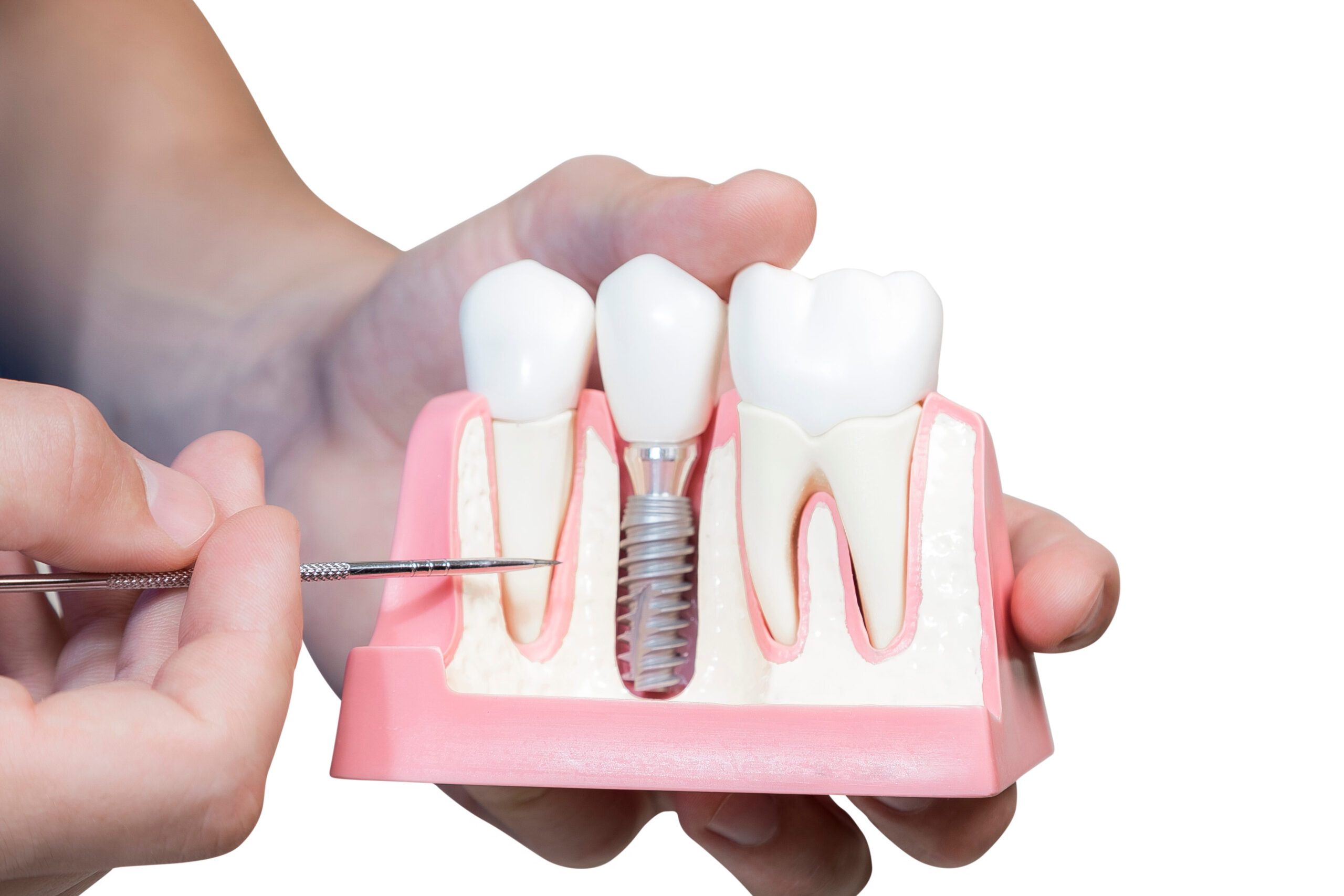 dental implants San Jose teeth implants